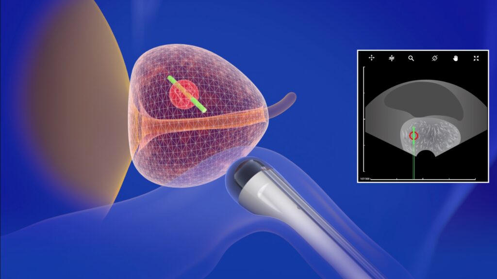 Биопсия простаты