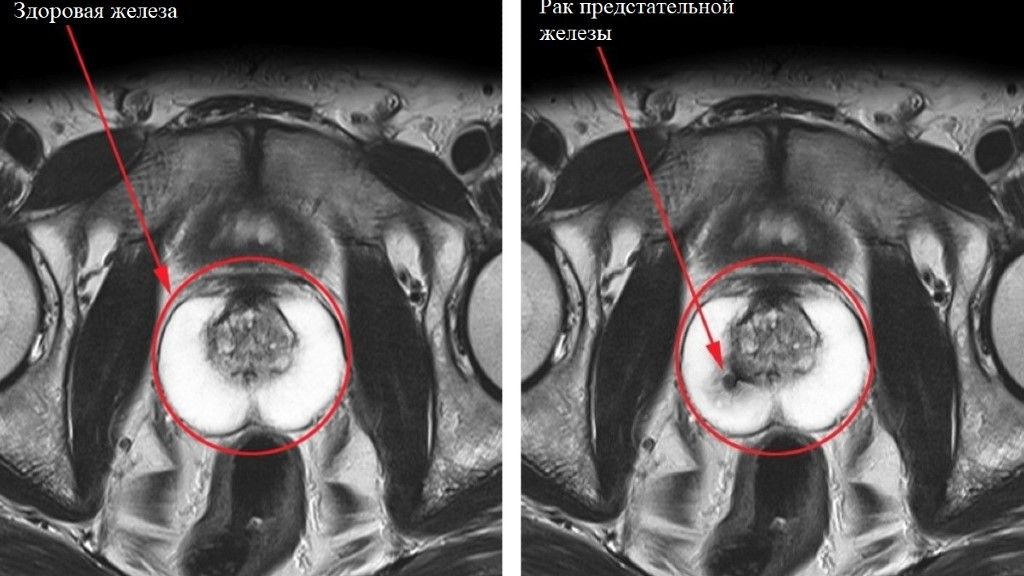 МРТ простаты
